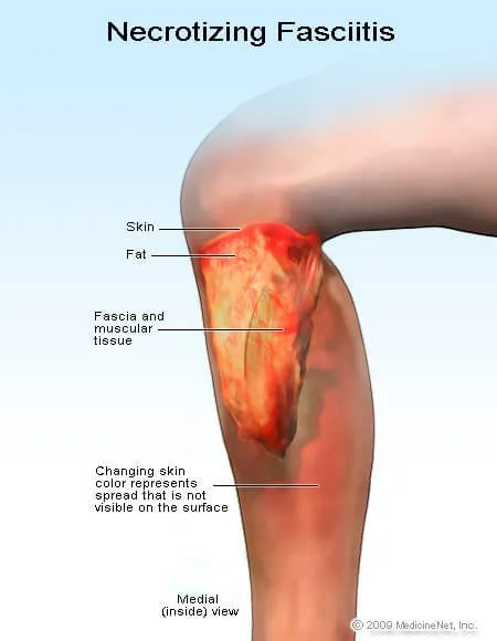 memahami-kesehatan-dan-penanganan-necrotizing-fasciitis