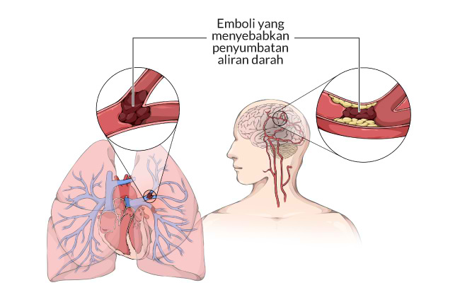 memahami-kesehatan-emboli-penyebab-gejala-dan-pencegahannya