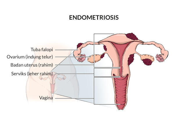 memahami-kesehatan-endometritis-penyebab-gejala-dan-pengobatan
