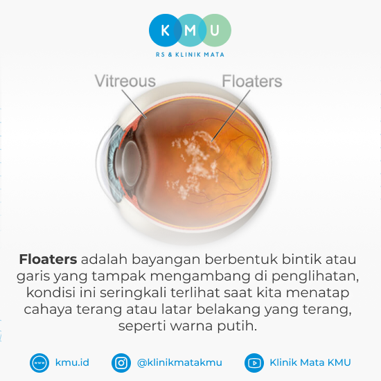 memahami-kesehatan-floaters-penyebab-gejala-dan-pencegahannya