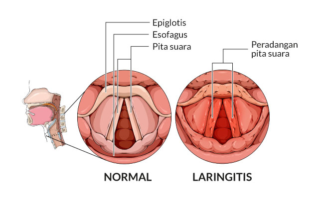 mengatasi-laringitis-penyebab-gejala-dan-cara-pencegahan