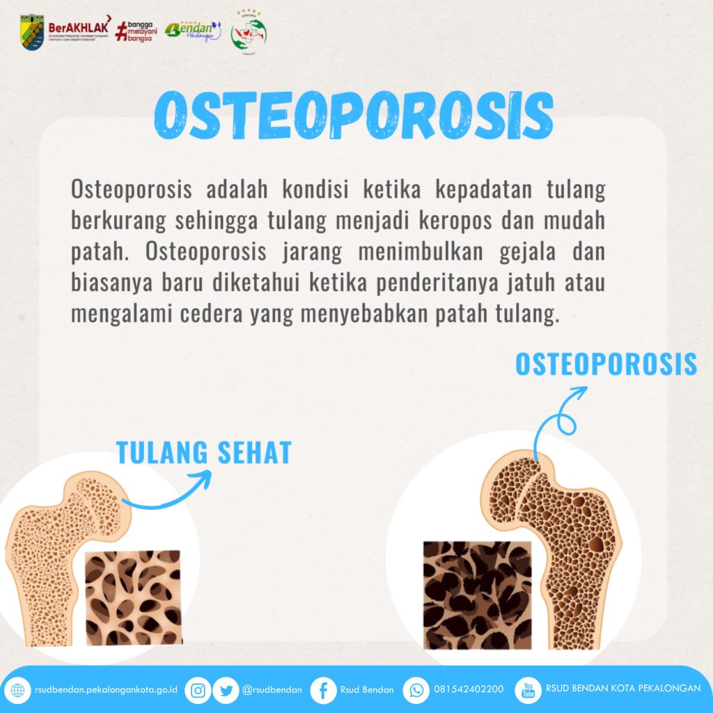 mengenal-kesehatan-osteoporosis-penyebab-gejala-dan-pencegahannya