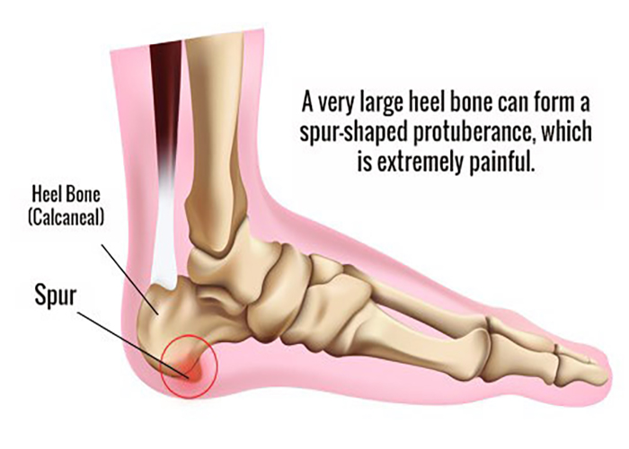 mengenal-osteofit-penyebab-gejala-dan-pengobatannya