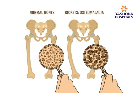mengenal-osteomalacia-penyakit-tulang-lemah-dan-pencegahannya