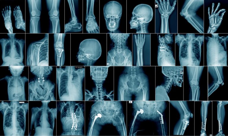 mengenal-osteomalacia-penyebab-gejala-dan-pengobatannya