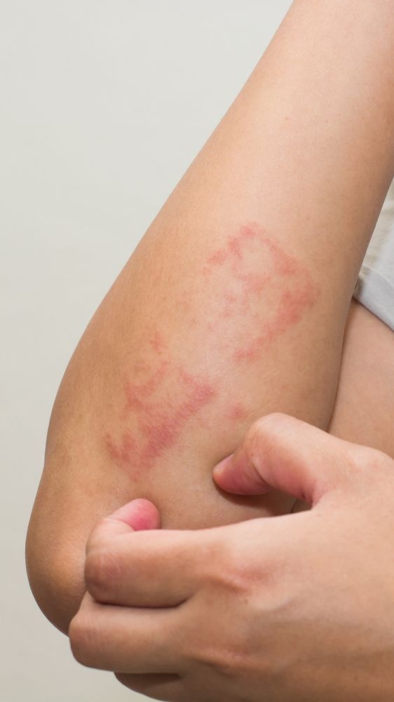 panduan-lengkap-mengenai-kesehatan-dermatitis-dan-cara-mengatasinya