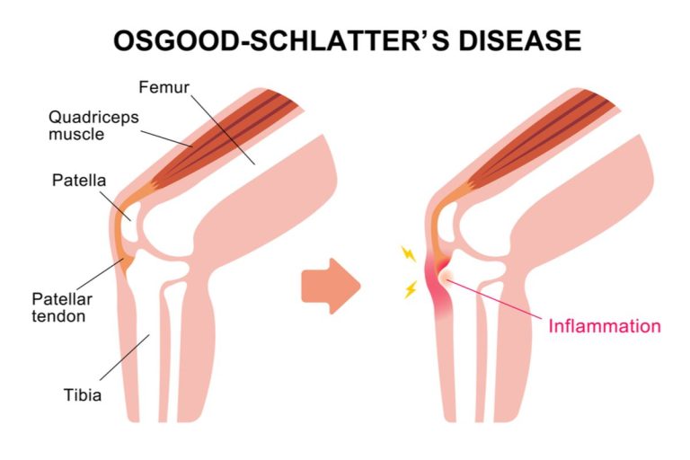 pemahaman-kesehatan-tentang-penyakit-osgood-schlatter