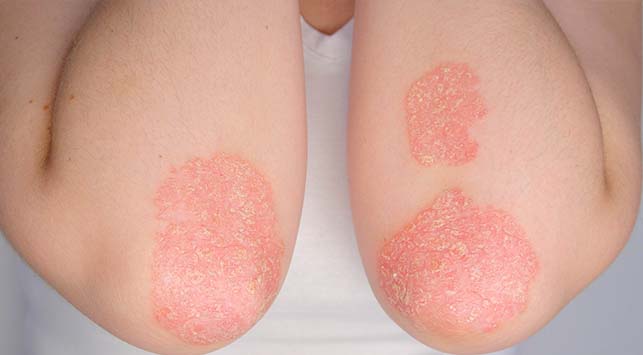 pemahaman-tentang-kesehatan-dan-gejala-nekrolisis-epidermal-toksik