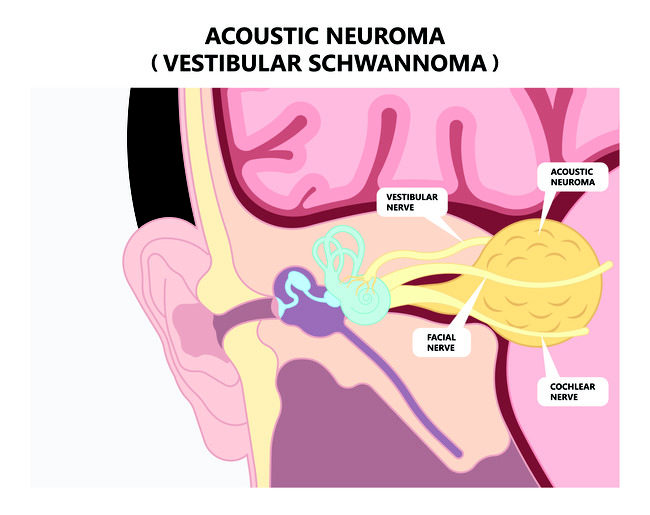 pemahaman-tentang-kesehatan-neuroma-akustik-dan-penanganannya