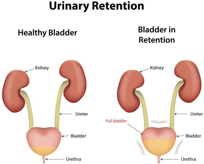 pemahaman-tentang-kesehatan-retensi-urine-dan-cara-pencegahannya