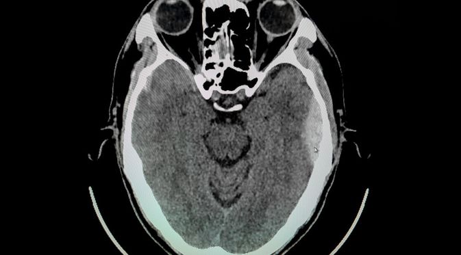 kesehatan-dan-penanganan-epidermal-hematoma-informasi-lengkap