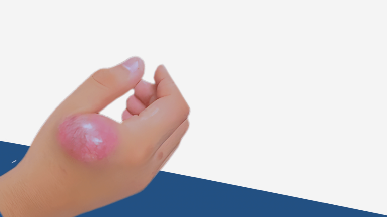 kesehatan-dan-penanganan-ewings-sarcoma-secara-komprehensif