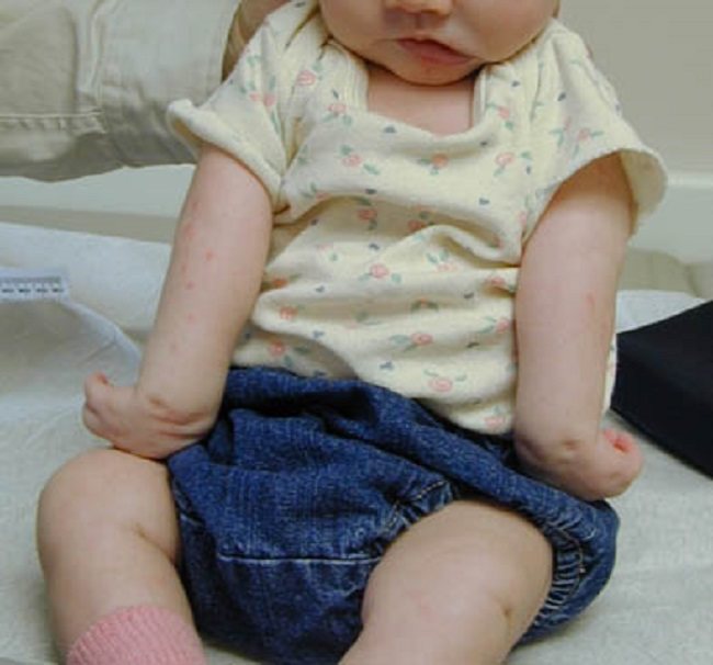 kesehatan-erbs-palsy-penyebab-gejala-dan-penanganan-tepat