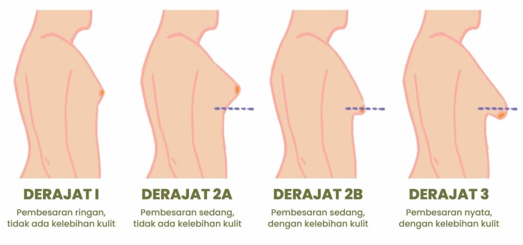 kesehatan-ginekomastia-penyebab-gejala-dan-pengobatannya