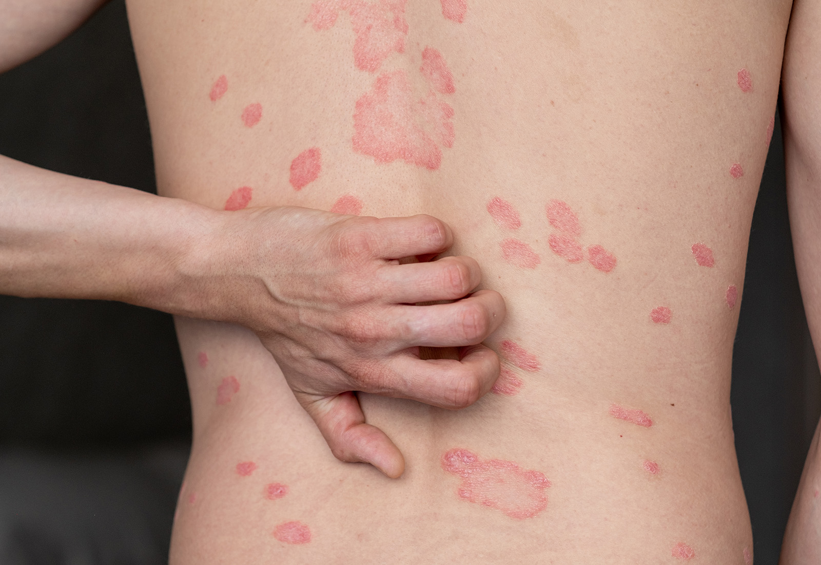 kesehatan-psoriasis-penyebab-gejala-dan-penanganan-terbaru