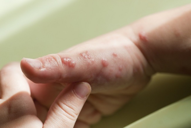 memahami-gejala-dan-pengobatan-kesehatan-herpes-secara-lengkap