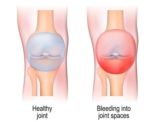 pemahaman-tentang-kesehatan-dan-pengelolaan-hemarthrosis